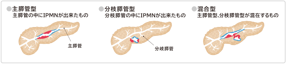 IPMNタイプ別分類